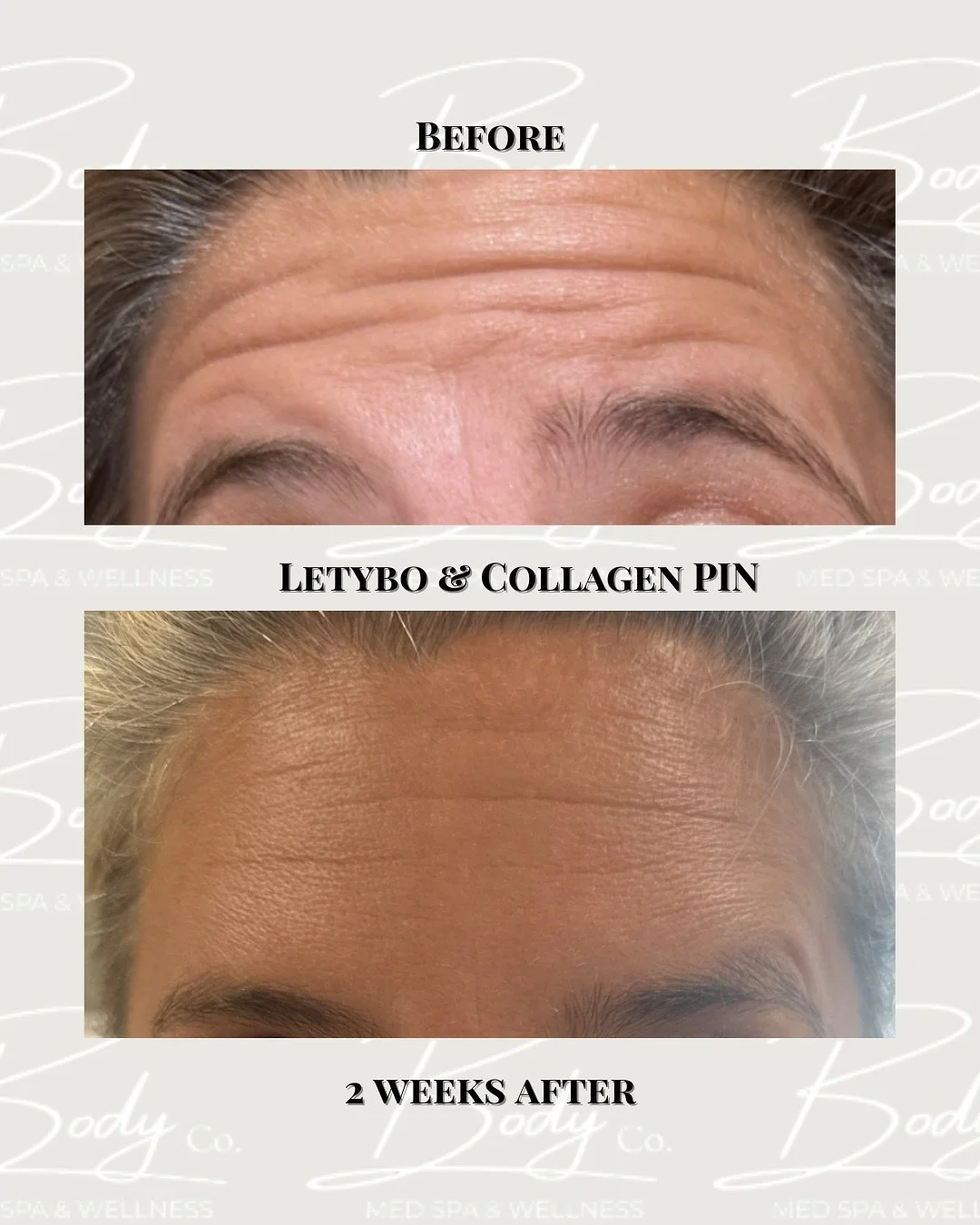 Make &lsquo;Em Say &ldquo;No&rdquo; this &ldquo;No-Vember&rdquo; to wrinkles. 

This beauty is had @collagen_pin treatment and Letybo injections to her forehead lines and between the brows (11&rsquo;s) with a smooth finish! 

@janelle_holland_wellnes