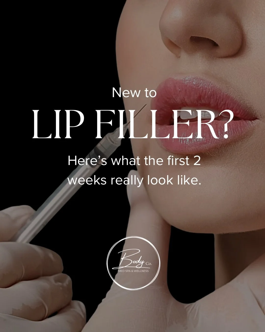 Having quite a few new lip filler clients recently- we wanted to talk about how Lip filler isn&rsquo;t a &ldquo;walk out perfect&rdquo; treatment &mdash; and that&rsquo;s completely normal.

Swelling, bruising, and temporary firmness are all part of 
