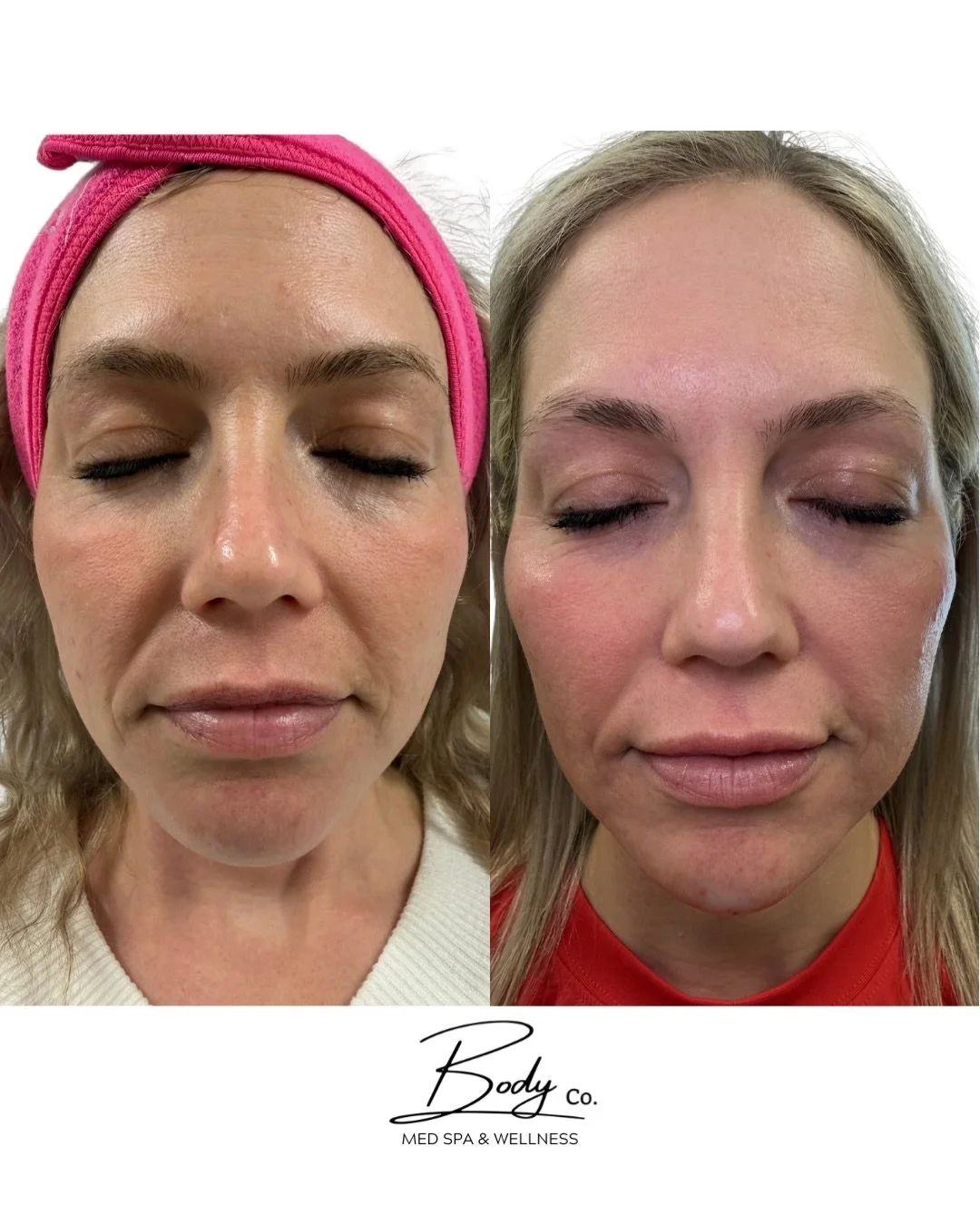 Not everything needs to be &ldquo;filled&rdquo;&hellip;sometimes it just needs to be restored.

For this transformation, we used a combination approach:
&bull; First, very important - RF microneedling to improve skin texture + tighten
&bull; Radiesse