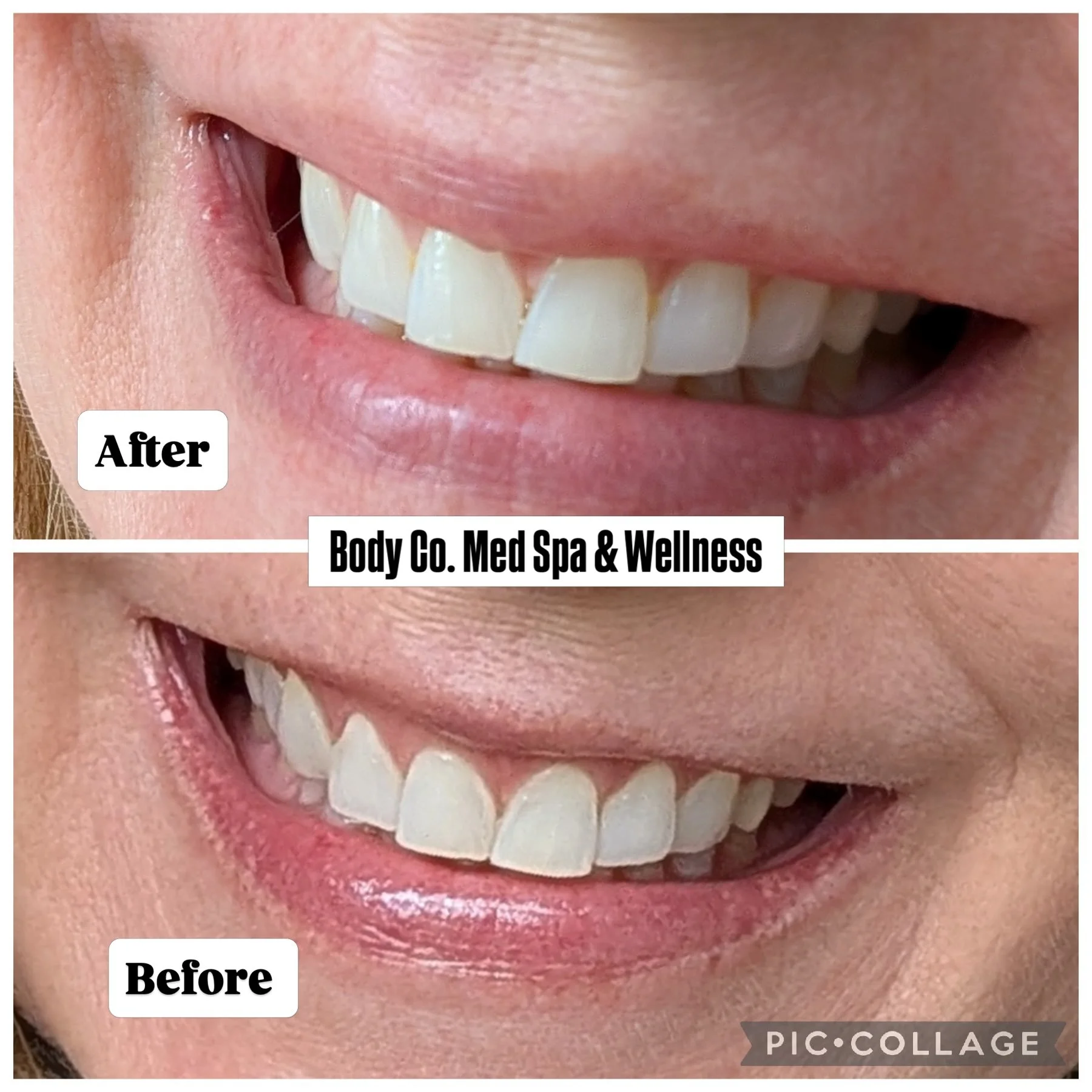 A beautiful result with no downtime? That&rsquo;s why we love a good lip flip! 

Just a small amount of Xeomin (aka B0T0X) just above the lip line, and in 1-2 weeks you have a fuller appearing upper lip 👄

Come see @thekcaestheticnp at Body Co. to s