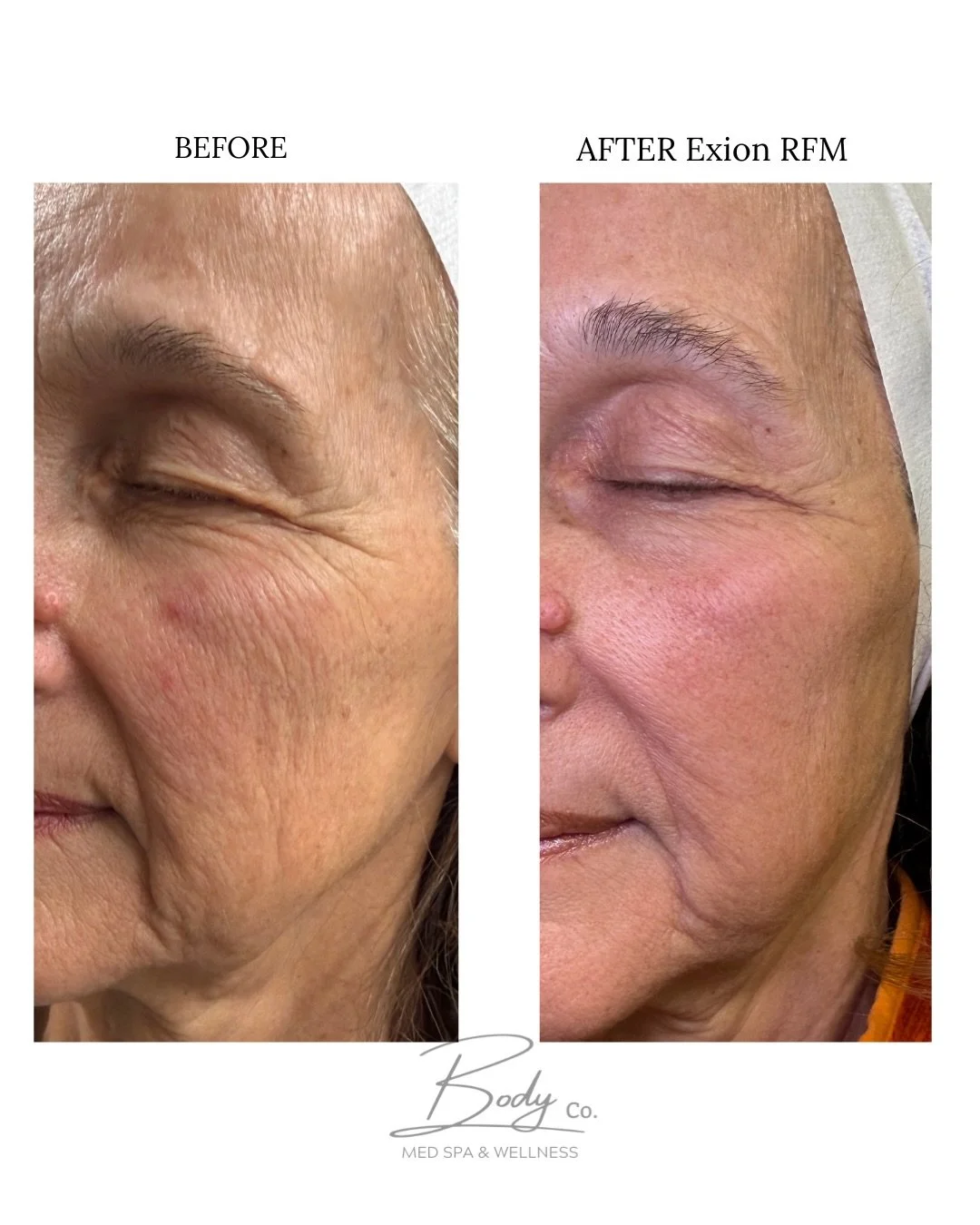 No, this isn&rsquo;t Botox or filler.

She committed to collagen-stimulating treatments&mdash;just one comfortable treatment every 4 weeks for 3 months, and the results speak for themselves.

Now what?

Results like these are maintained, not finished