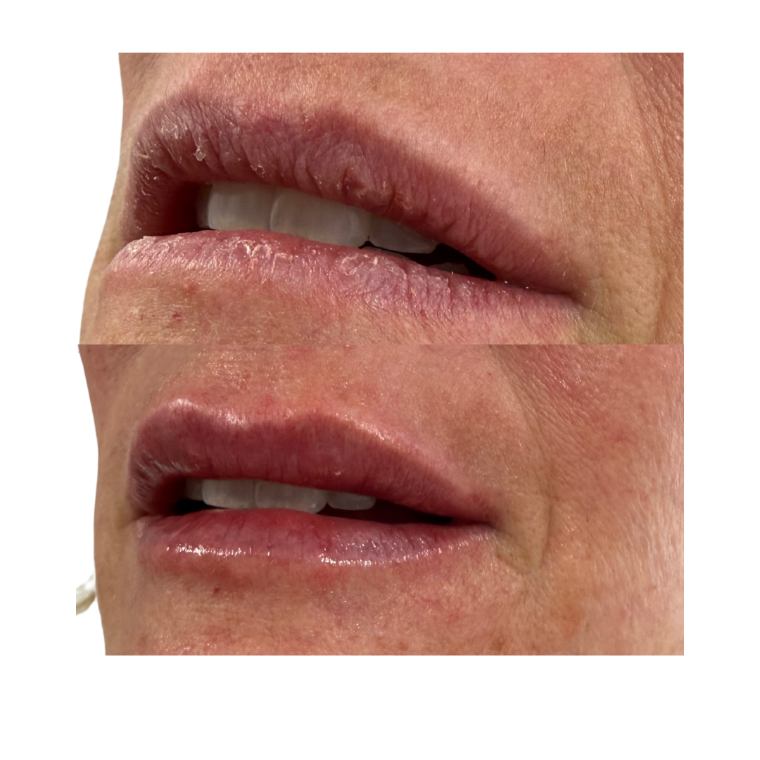 Before and After lip Filler using Revance RHA dermal filler 