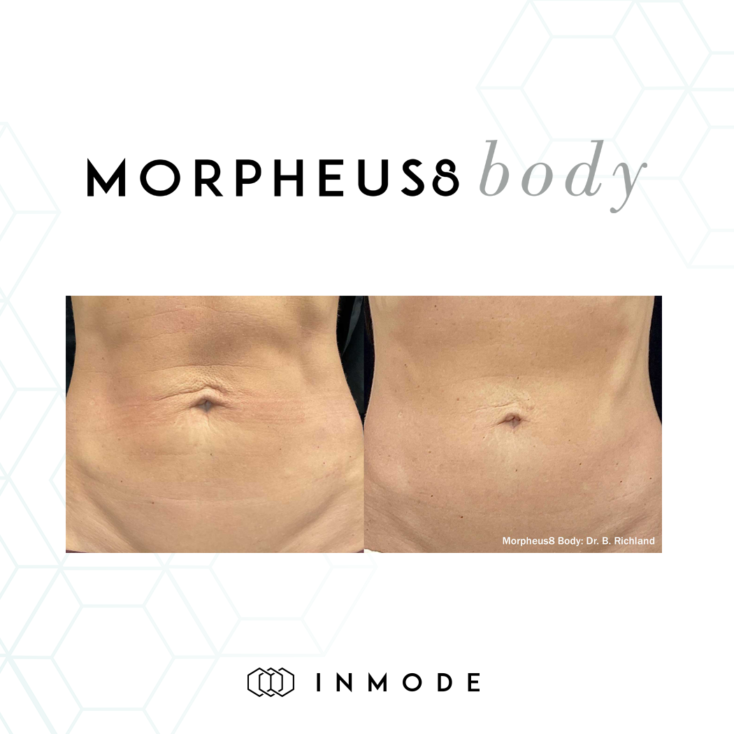 Morpheus 8 Body Tightening