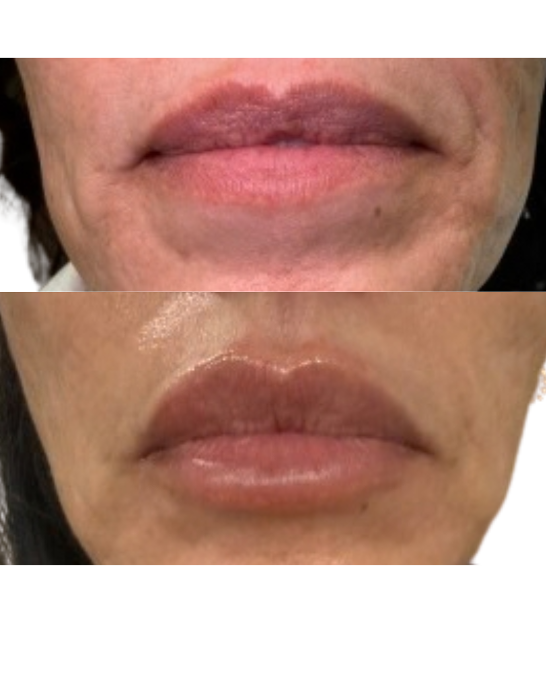 lips with volume and augmentation from injectables