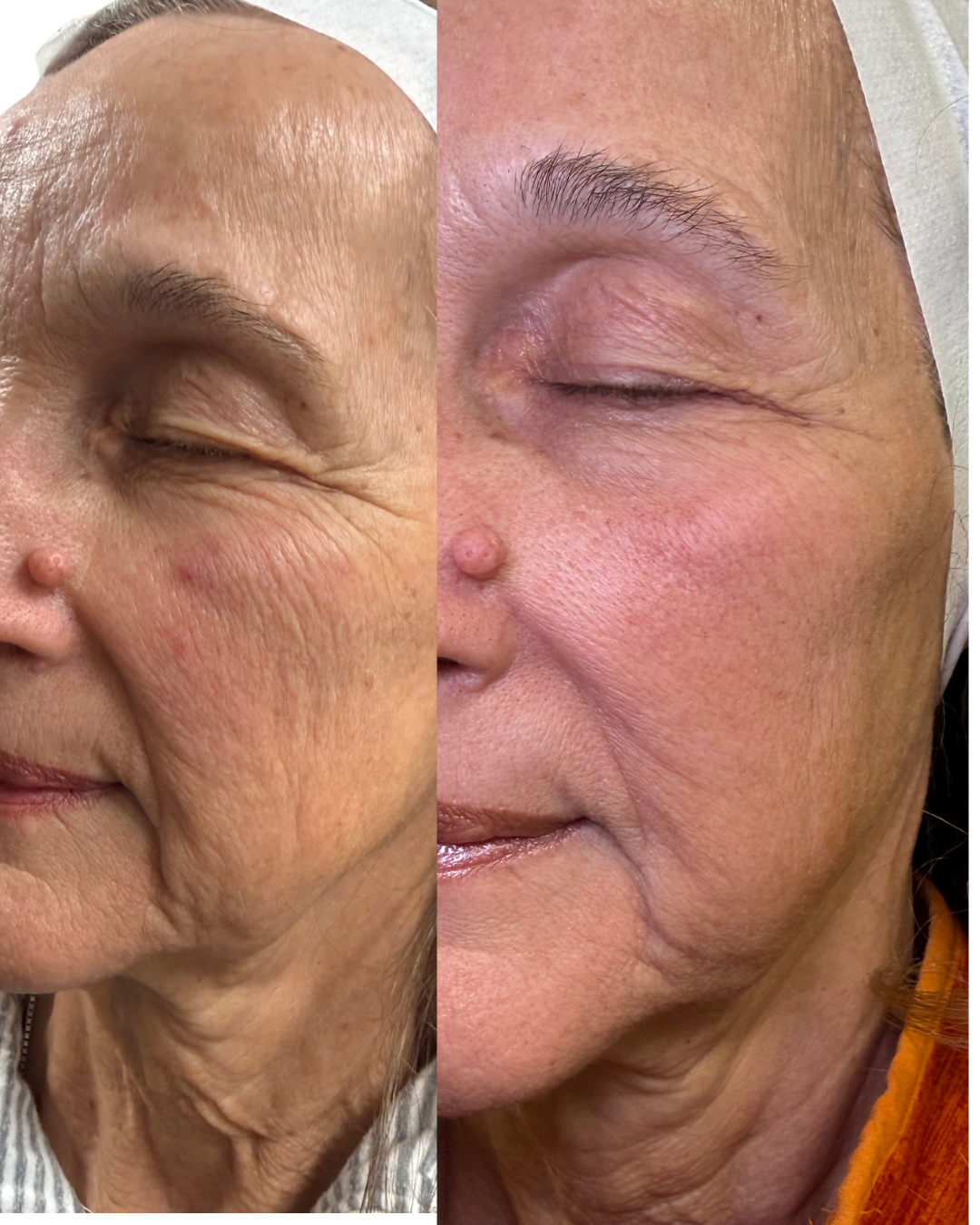 Before and after Exion RF microneedling, skin tightening 