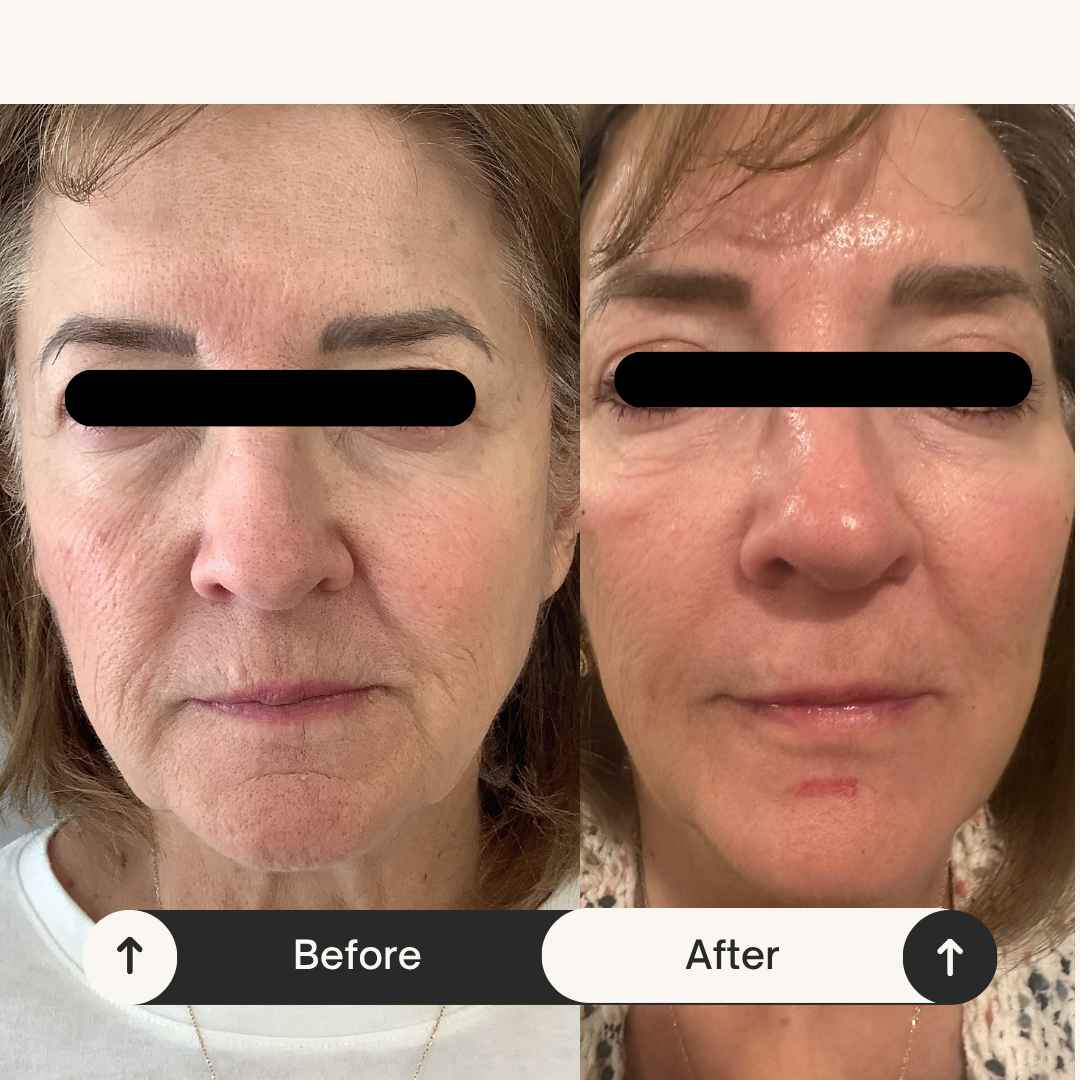 Before and After RF Microneedling and Radiesse Biostimulation Treatments