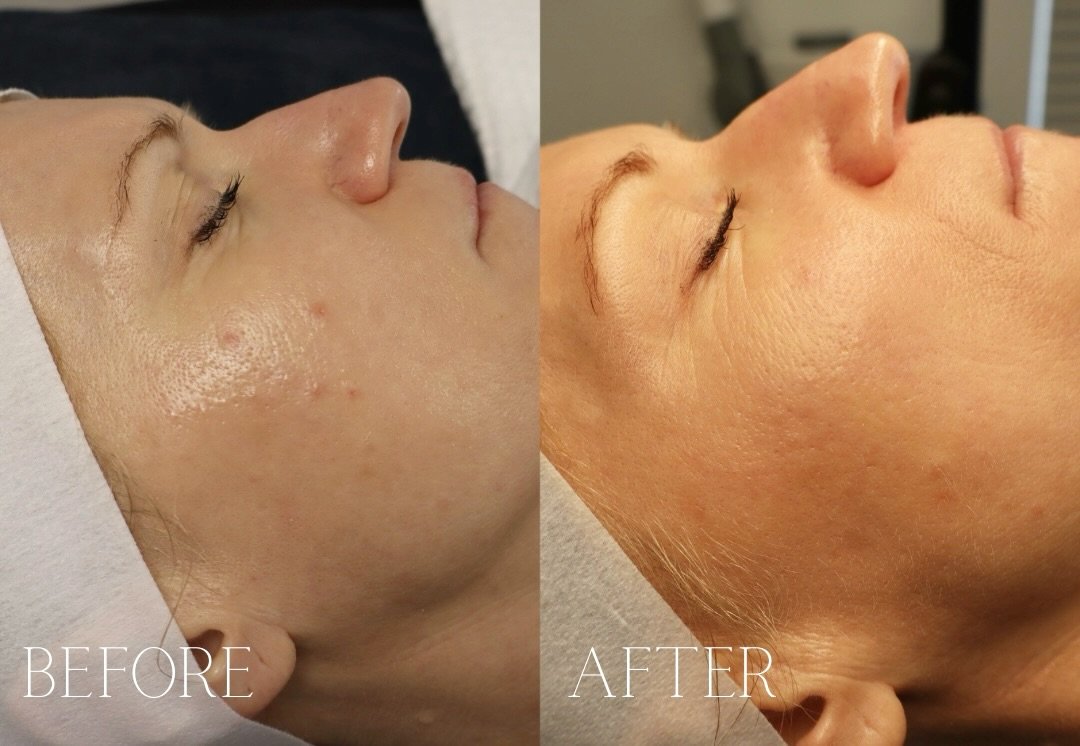 Another successful Acne Bootcamp client 💙

- We worked on mild combination acne and here shows mostly the inflamed acne. The non-inflamed acne was hard to picture so I don&rsquo;t have a close-up of that!!