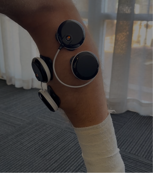 Foot with a bandage on the ankle, connected to a medical device with multiple black circular components and white tubing, in a room with curtains and a window.