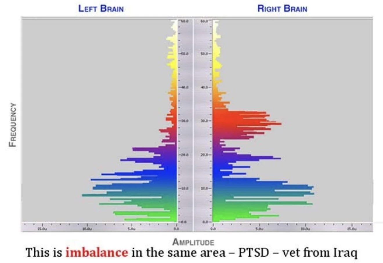 Balanced brain activity graph comparing left and right hemispheres, with color-coded amplitude and frequency data, illustrating PTSD in a veteran from Iraq.