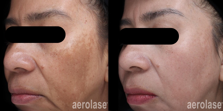 Melasma - jason emer, MD.png