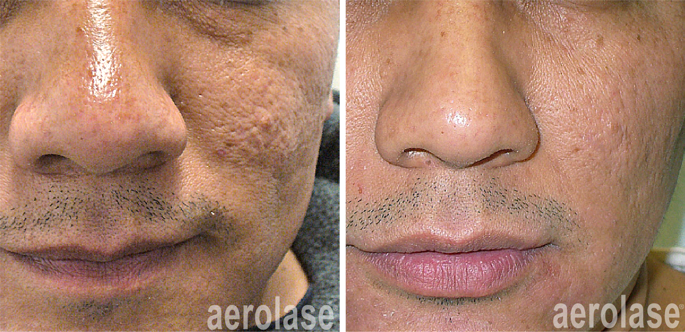 aerolase-skin-rejuvenation-fran cook bolden-after-7-treatments.png