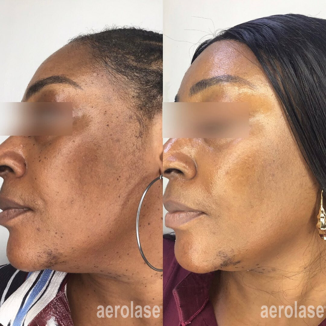 Melasma - Sholema Clinics.png