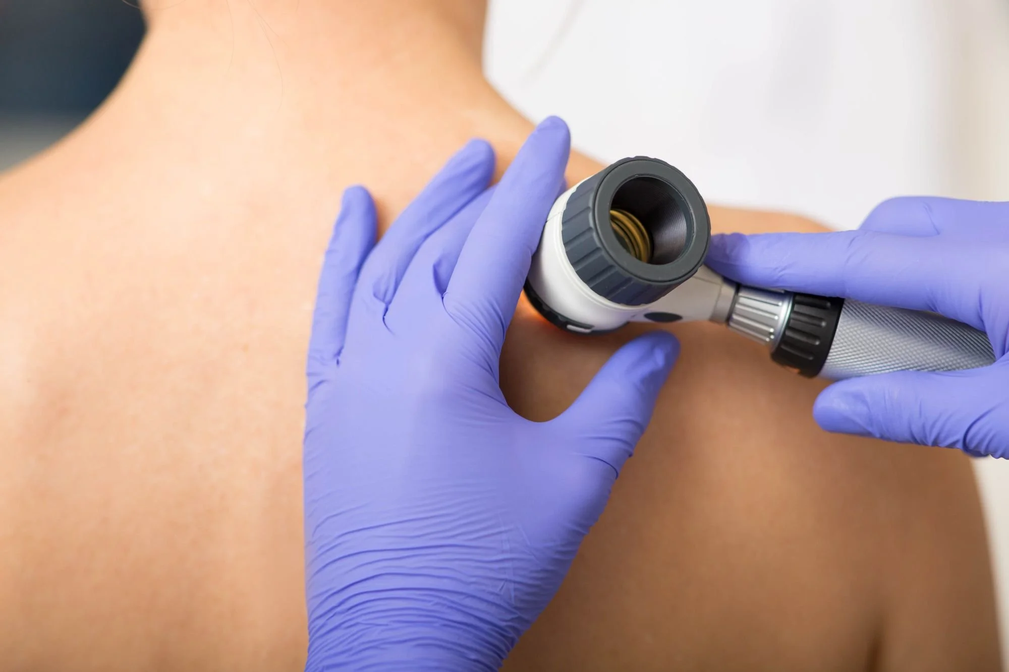 Melanoma_Skin Cancer_Mole Check.jpeg