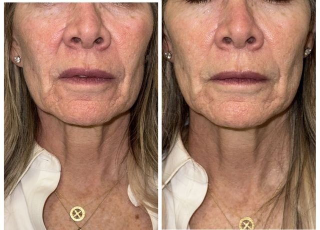 Noninvasive Facelift Session 1