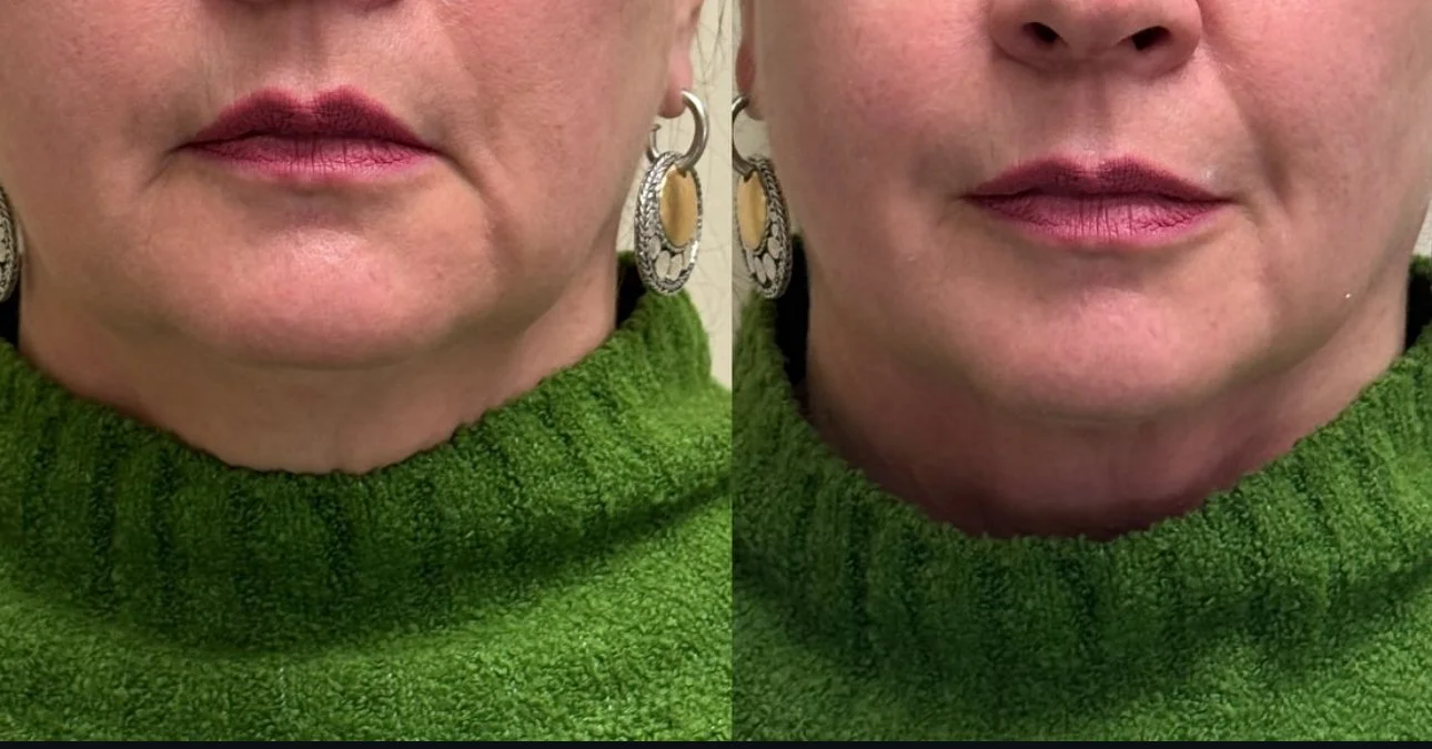 Snatched Jaw & Chin