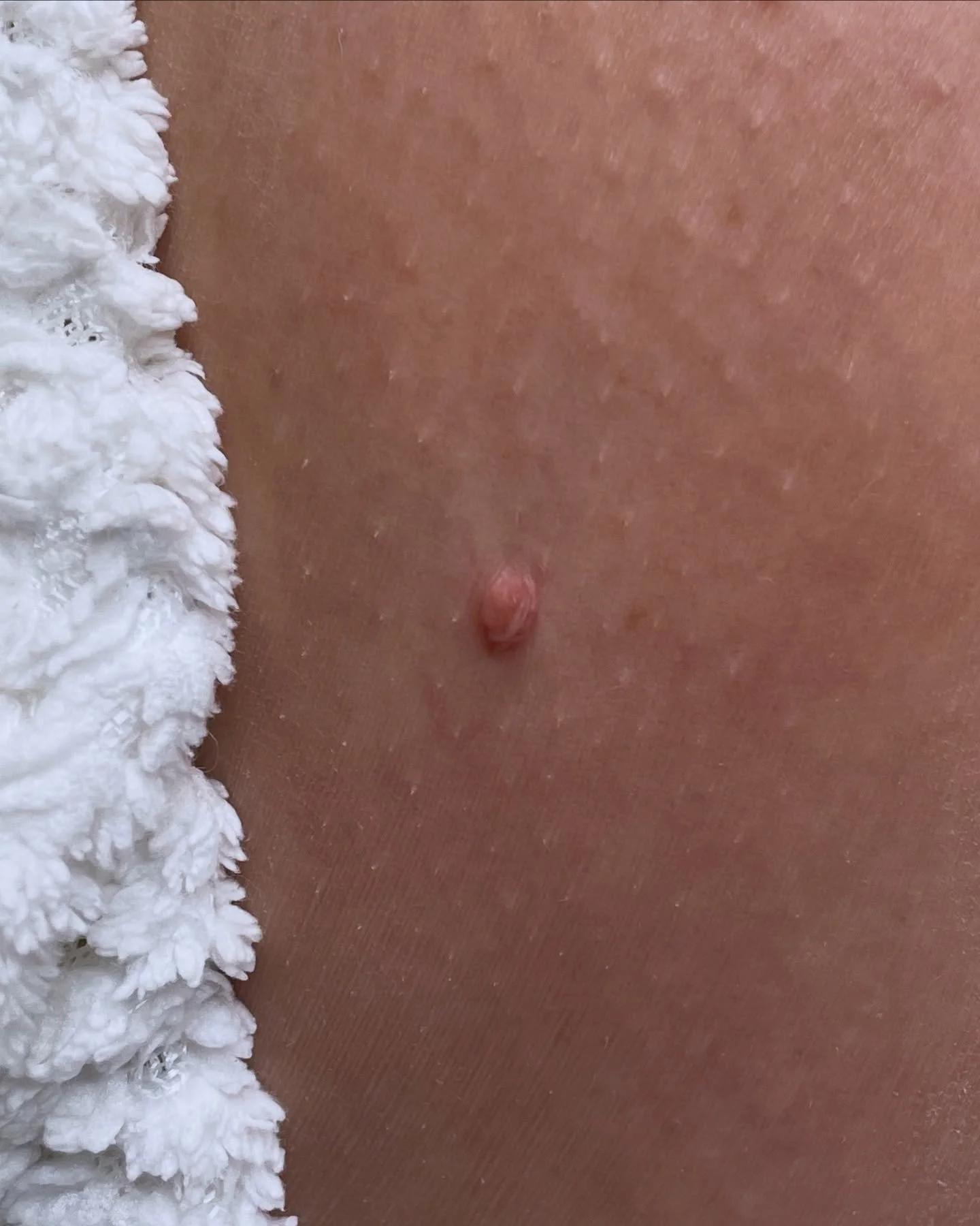 Bye-bye, skin tag &mdash; hello smooth skin!
Swipe to see the instant difference after a quick and easy removal.  #thermoclear #clearskingoals #vancouversmallbusiness #vancouvermasteresthetician #pnwmasteraesthetics #skintagremoval