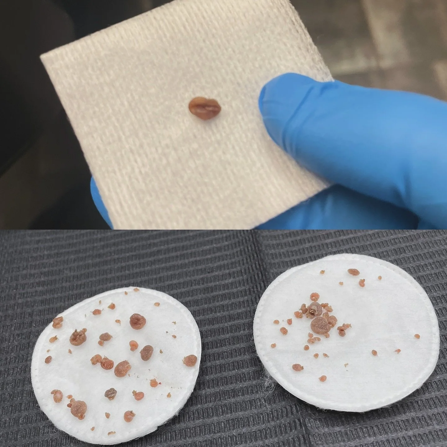 Skin tags are common and harmless, but they don&rsquo;t have to be permanent. Our professional skin tag removal treatment offers safe, effective results, leaving your skin smooth and clear. 

 

#skintagremoval #thermoclearusa #masteresthetician #pnw