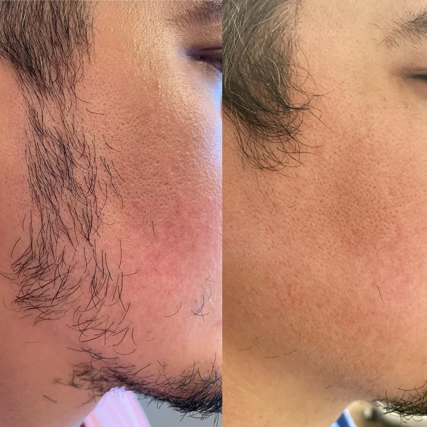 Laser hair removal after only two sessions &mdash; and the results are amazing! ✨ smoother, softer, and clearer-looking skin with each treatment.  #laserhairremoval #faciallhr #beforeandafter #truelyesthetic #vancouverwaesthetics #smoothskinjourney #