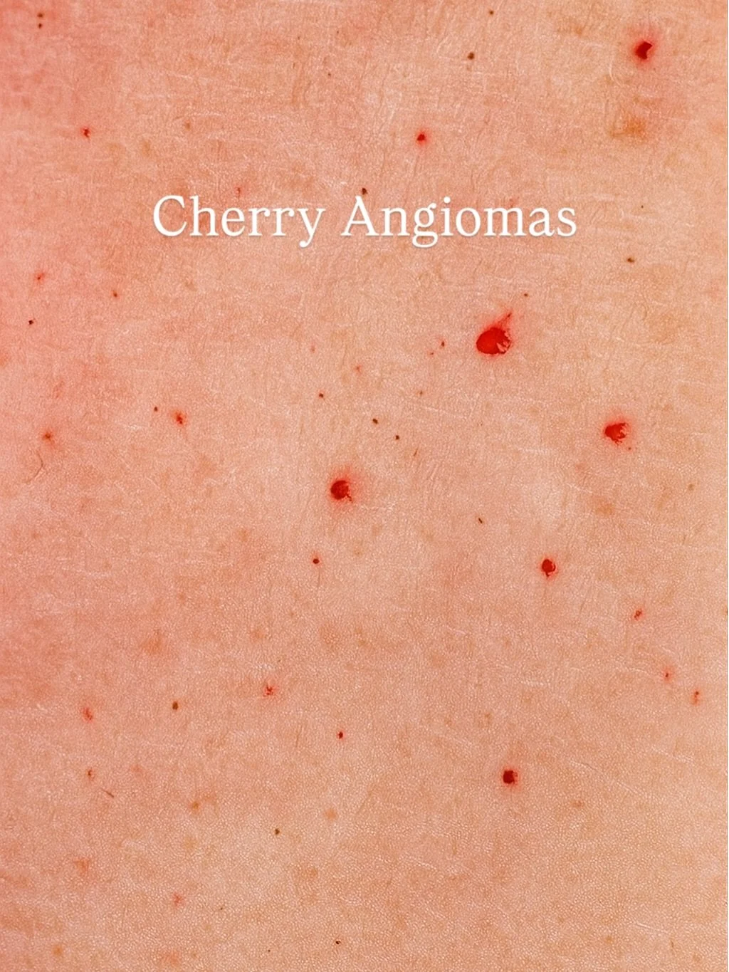 Cherry angiomas are benign vascular growths made up of small clusters of capillaries near the skin&rsquo;s surface. They often appear as bright red or purple spots and are most common on the torso, arms, and shoulders.

They can develop due to geneti