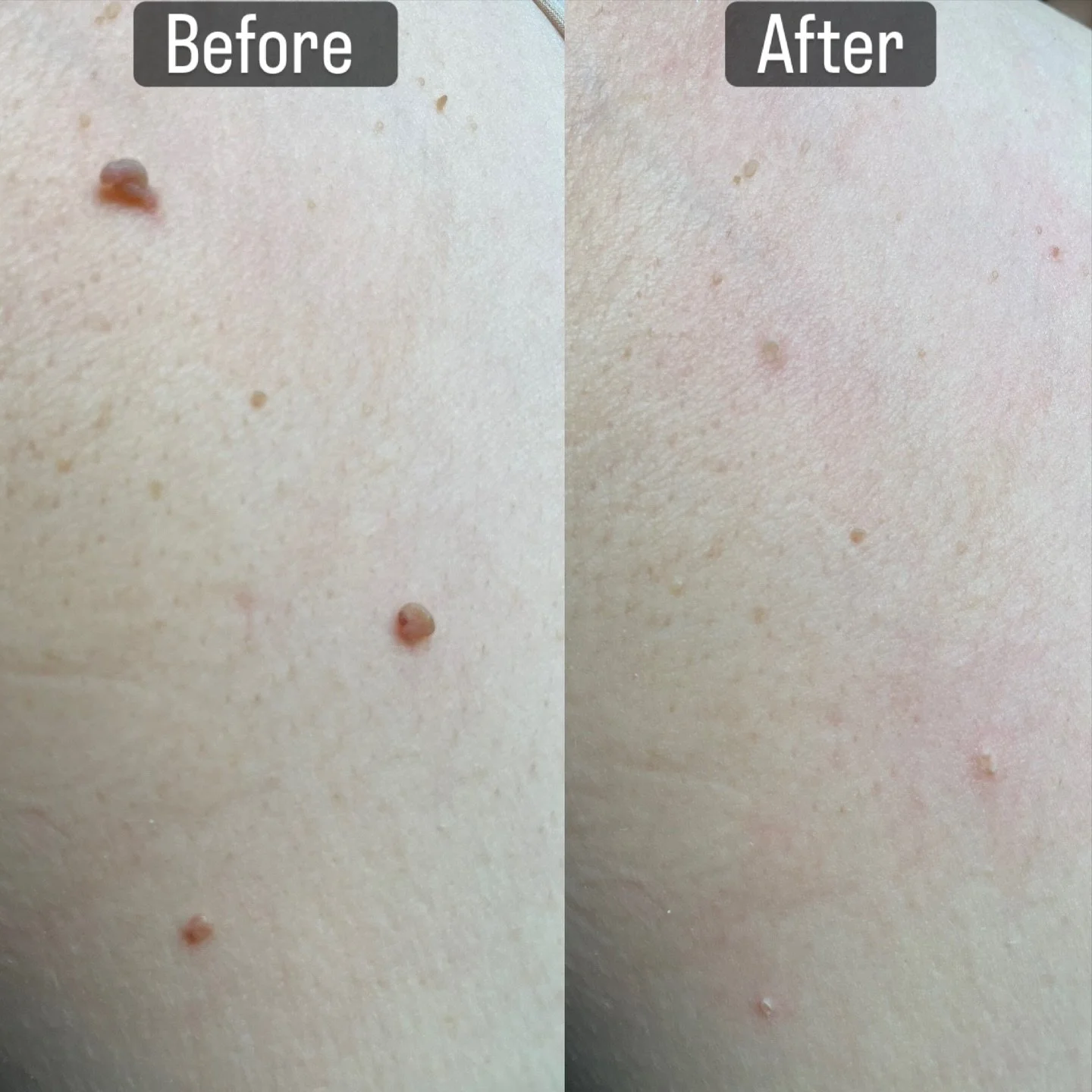 Instant gratification! Skin tags removed in seconds! 

  #skintagremoval #masteresthetician #clearskin #vancouverwa #thermoclear #smallbusiness #pnwesthetician #facial #microneedling #chemicalpeel #dermaplaningfacial #holidayready #advancedesthetics