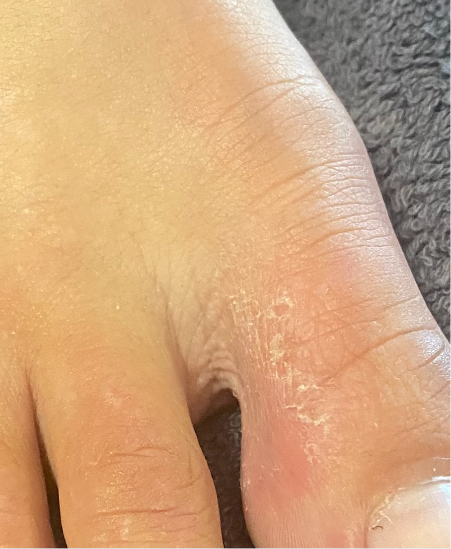 Nahaufnahme eines Fingers, bei dem die Haut an der Seite rissig und trocken ist.