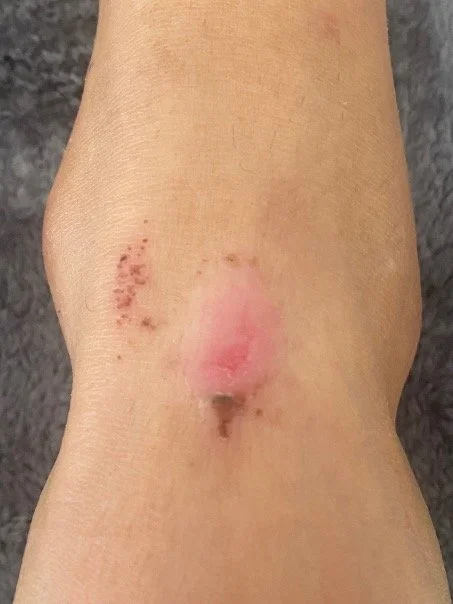Haut an einer Stelle mit Entzündung, Rötung und Krusten, mögliche Verletzung oder Infektion.