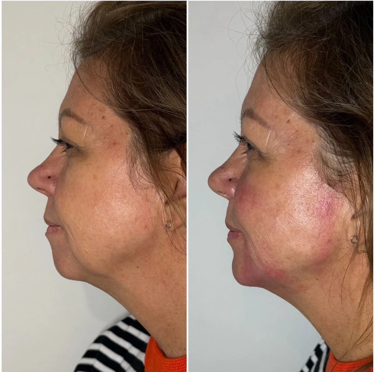 5 Reasons to Consider Dermal Fillers