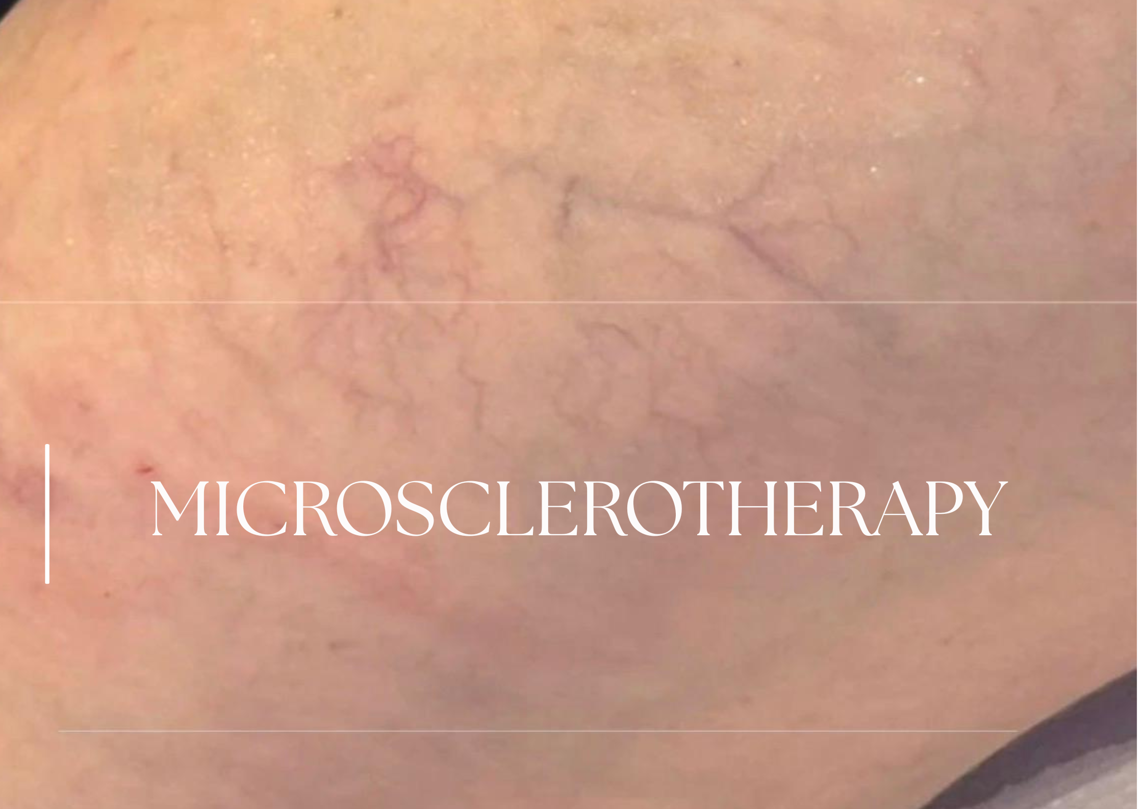 Cost of spider vein treatment. Cost of Microscleropy thread vein treatment in bournemouth