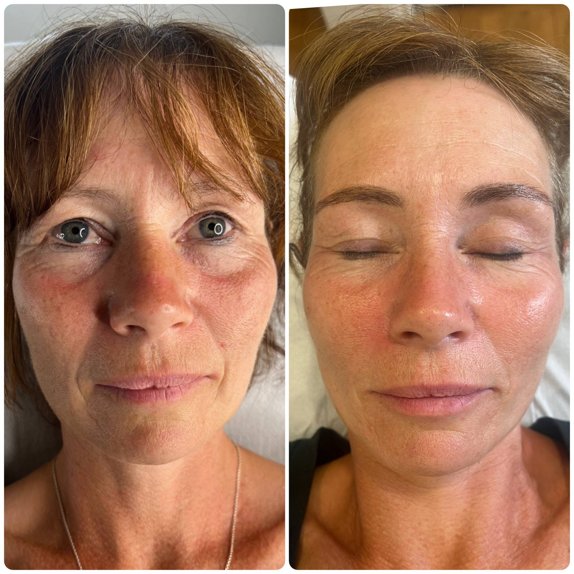 Before and after of patient who has had microneedling course in Christchurch, Dorset