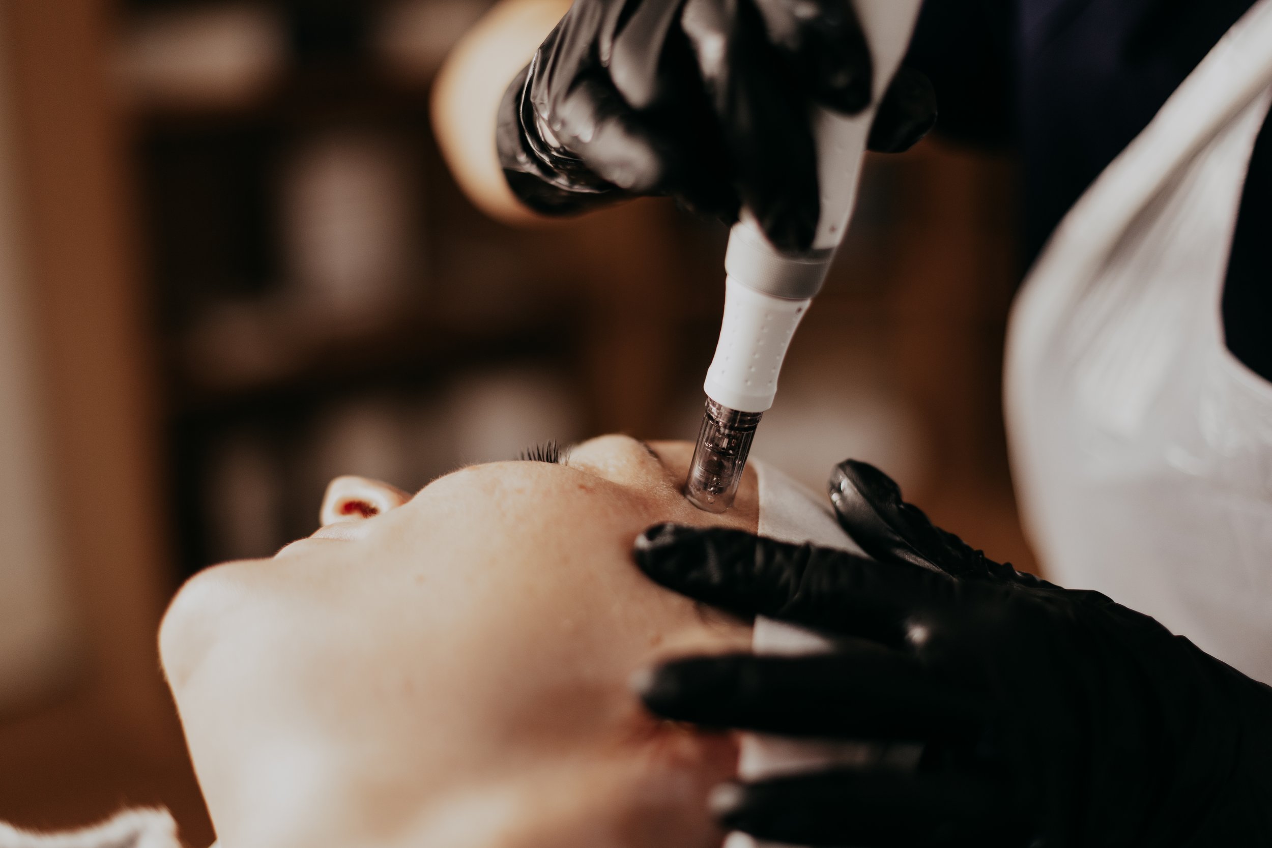 Microneedling near Christchurch Uk.