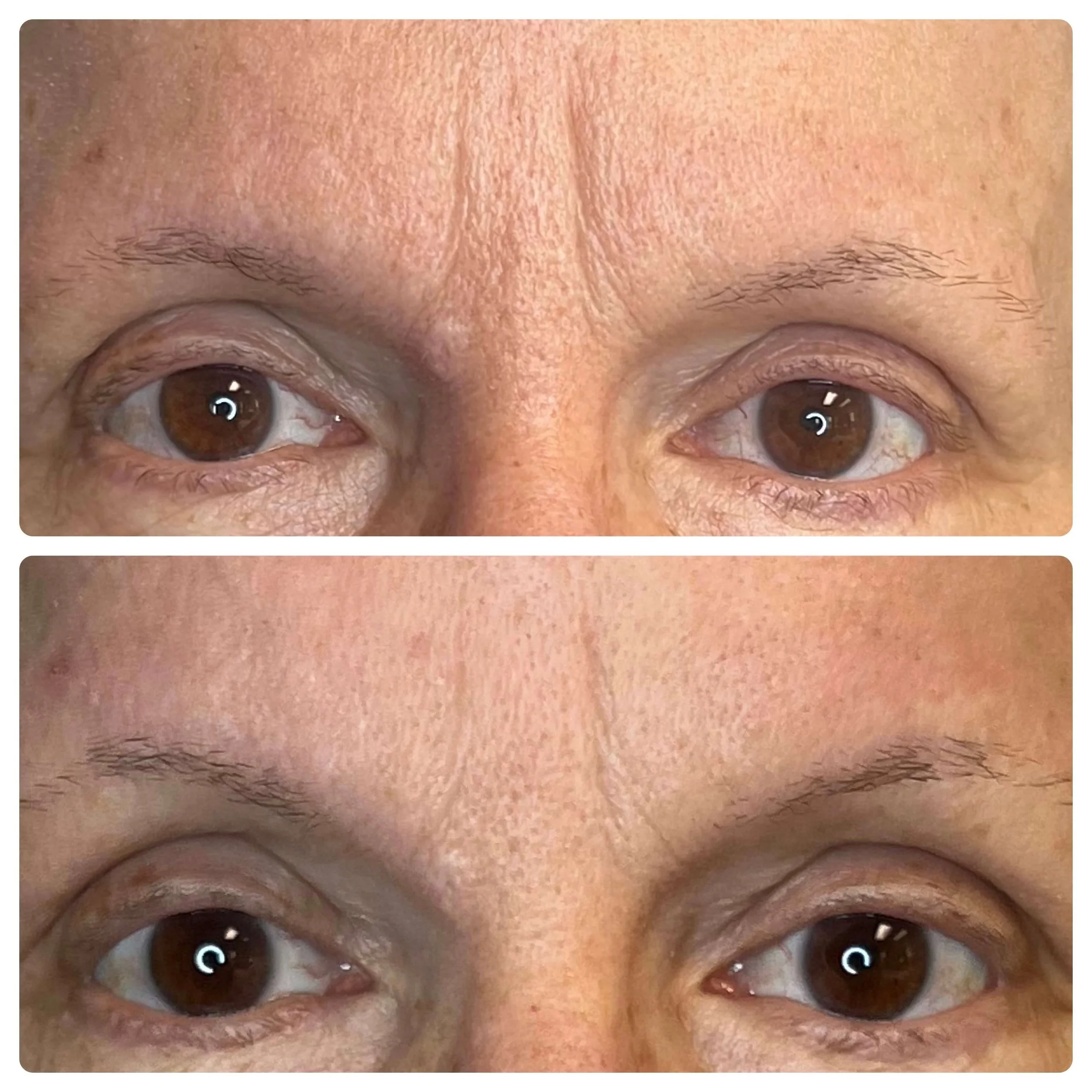 Before and After Microchanneling Treatment