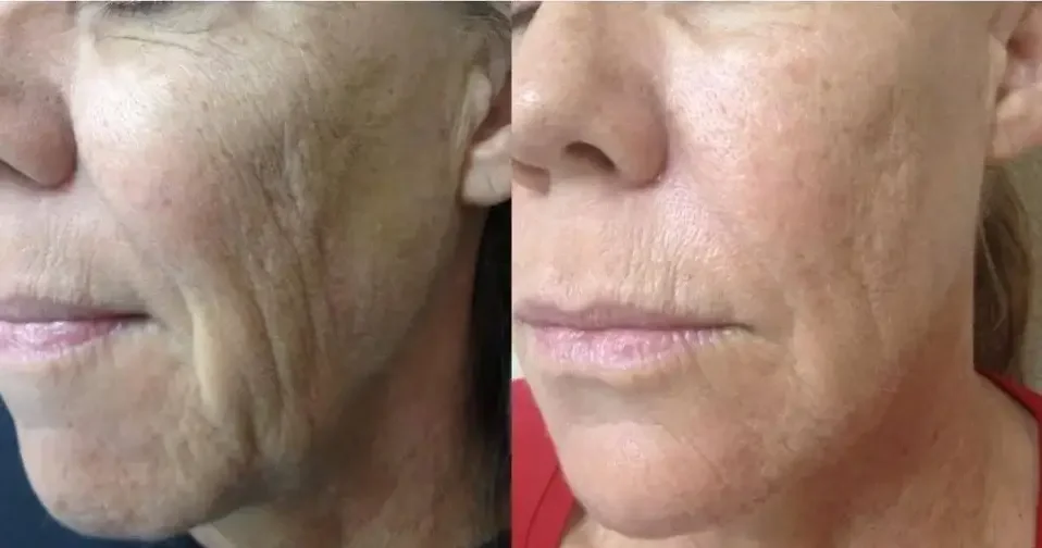 Before and After Microcurrent & Chemical Peel Facial Treatment