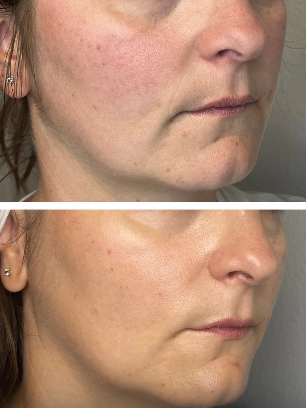 Before and After Procell Microchanneling Treatment