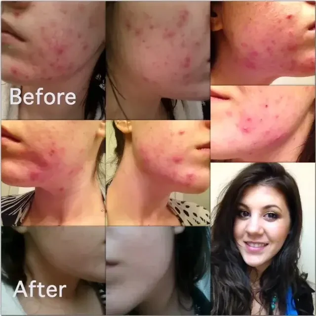 Melanie's Acne Journey