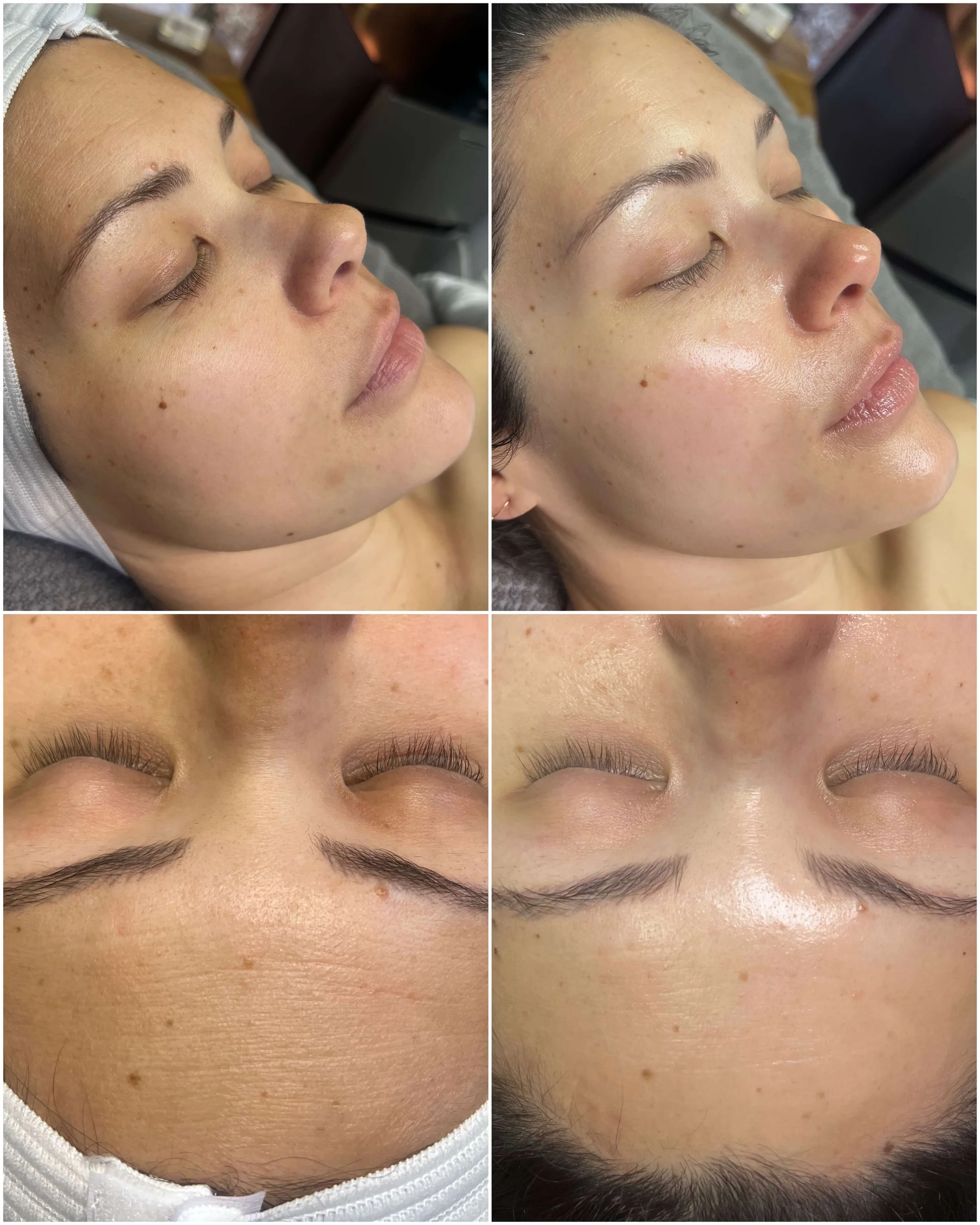 Before and After Barrier Support Hydration Facial