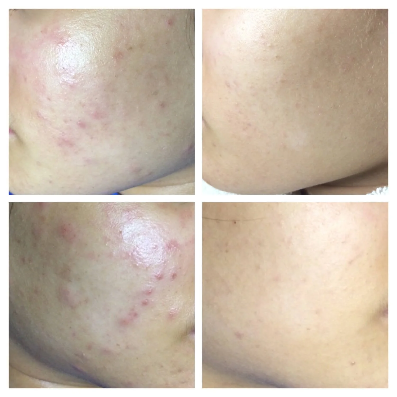 Before and After Acne Treatments and Custom Skincare Routine