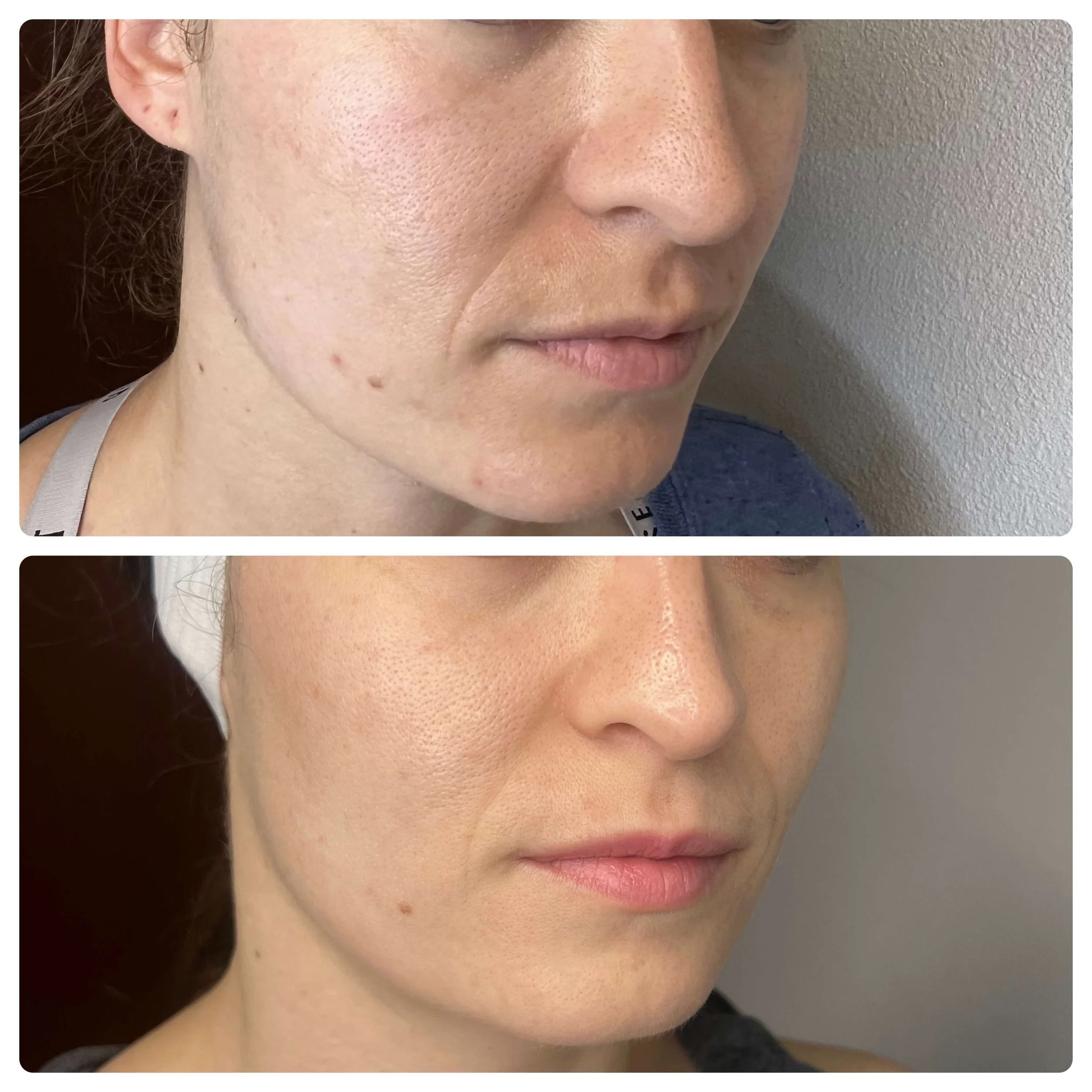 Before and After Procell Microchanneling