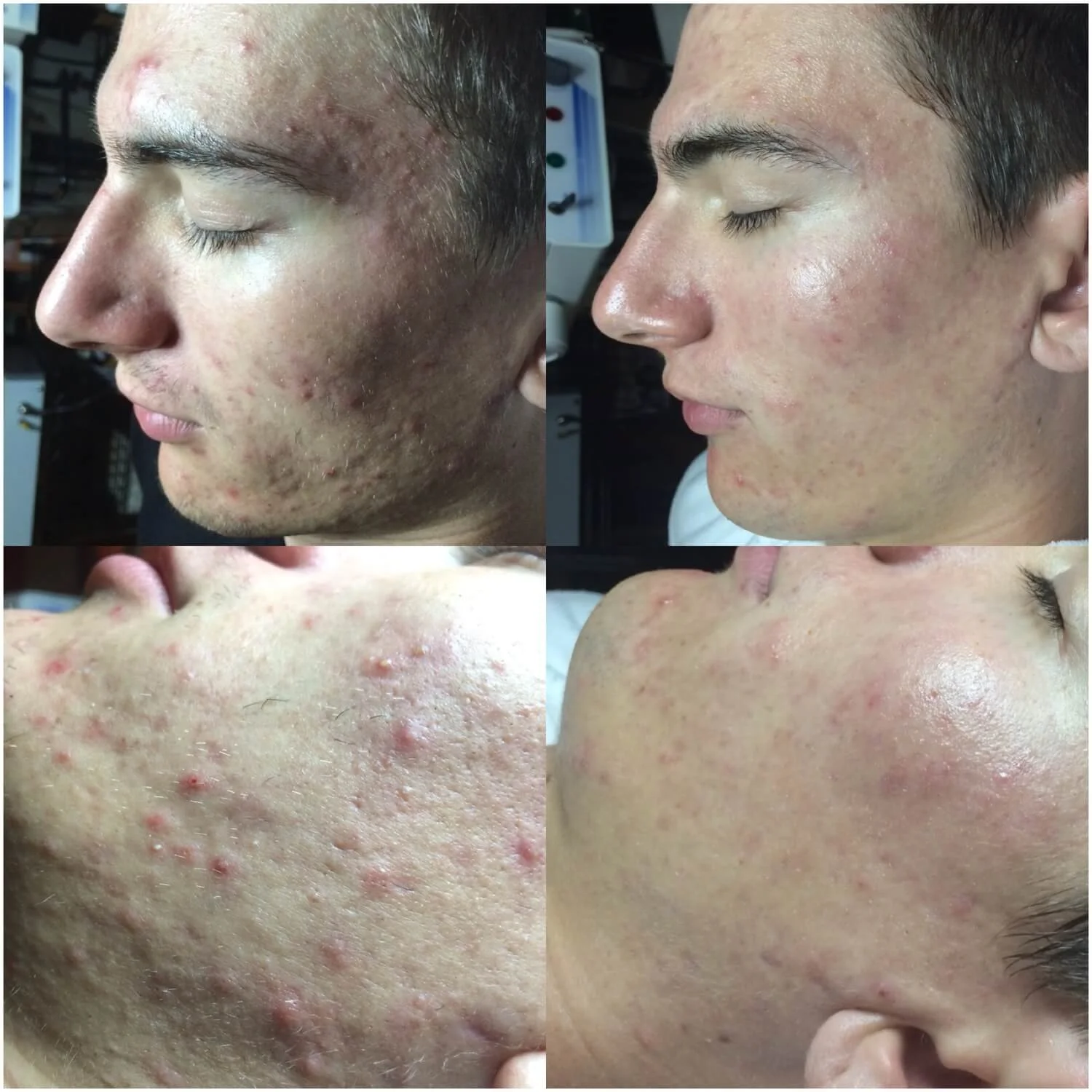 Before and After Acne Treatments and Skincare Routine