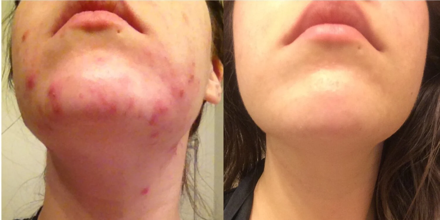 Before and After Acne Skincare Routine