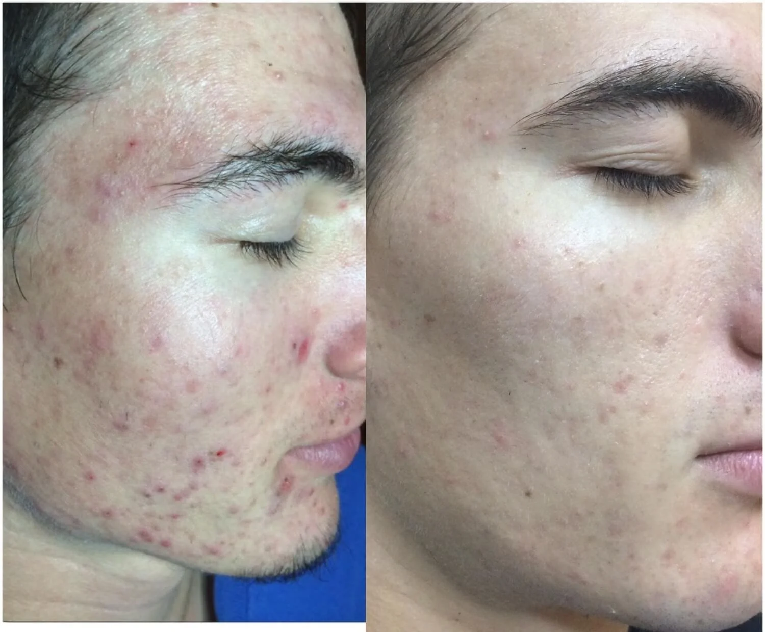 Before and After Acne Treatments and Skincare Routine