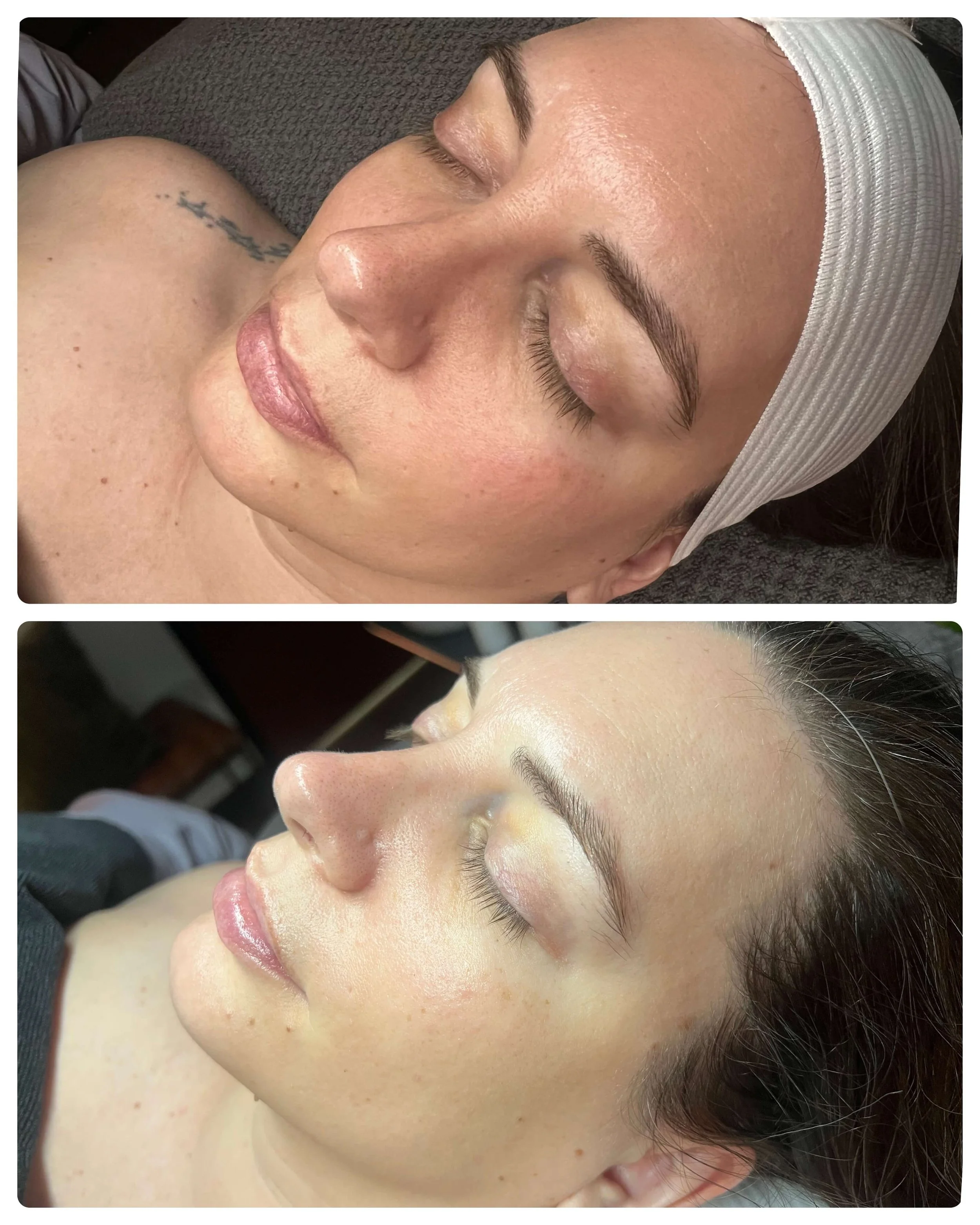 Before and After Barrier Support Hydration Facial