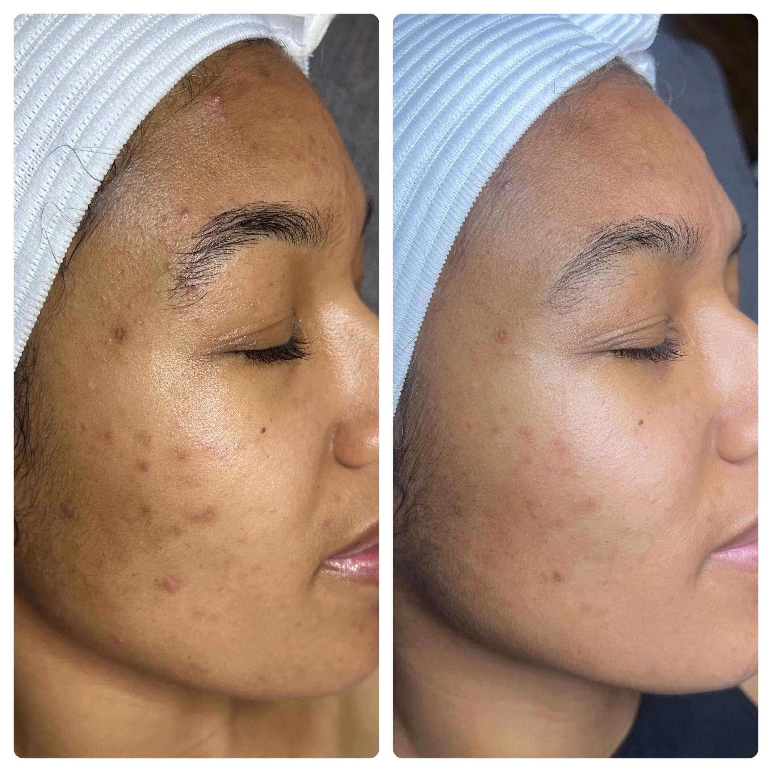 Before and After Acne Treatment