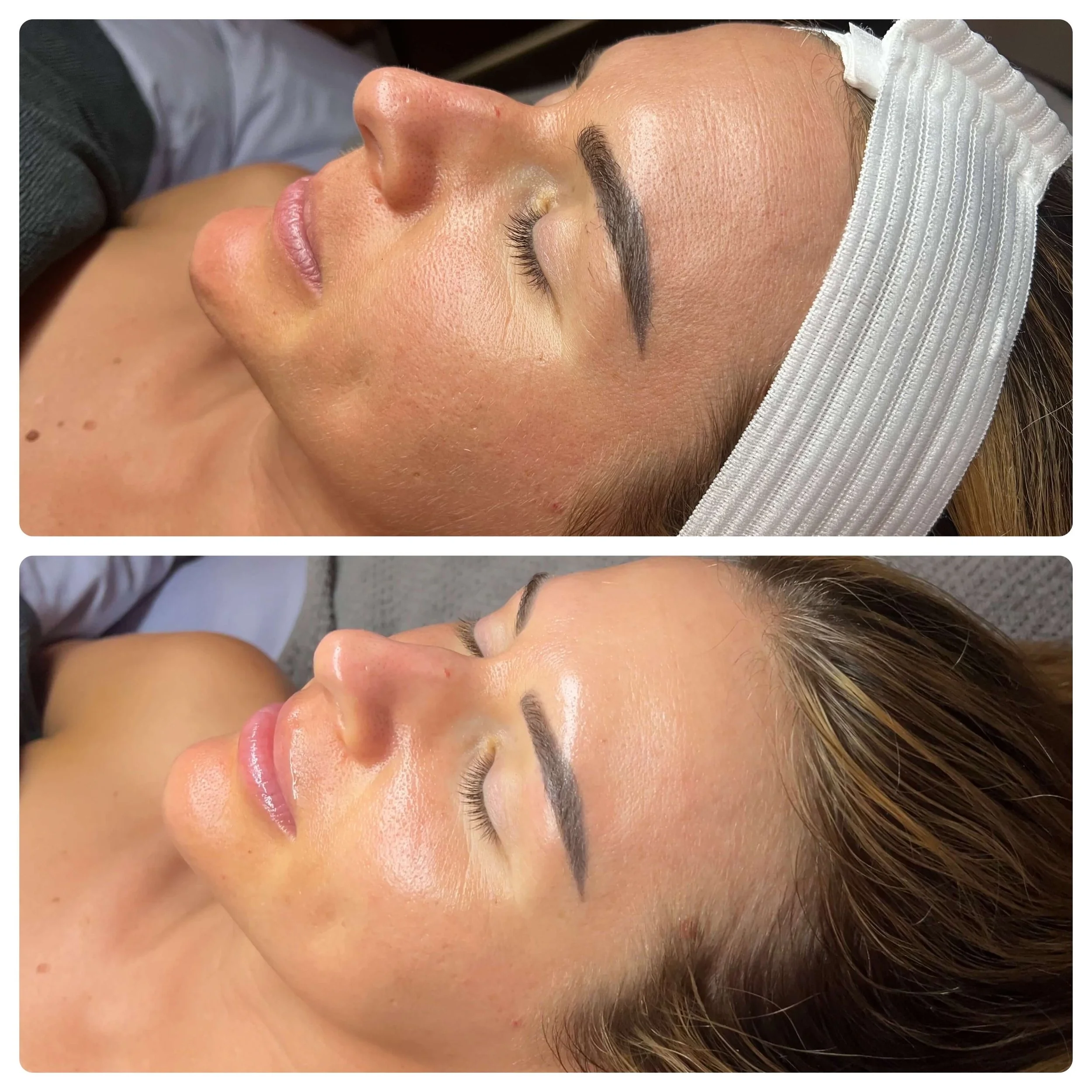Before and After Nano Infusion Treatment