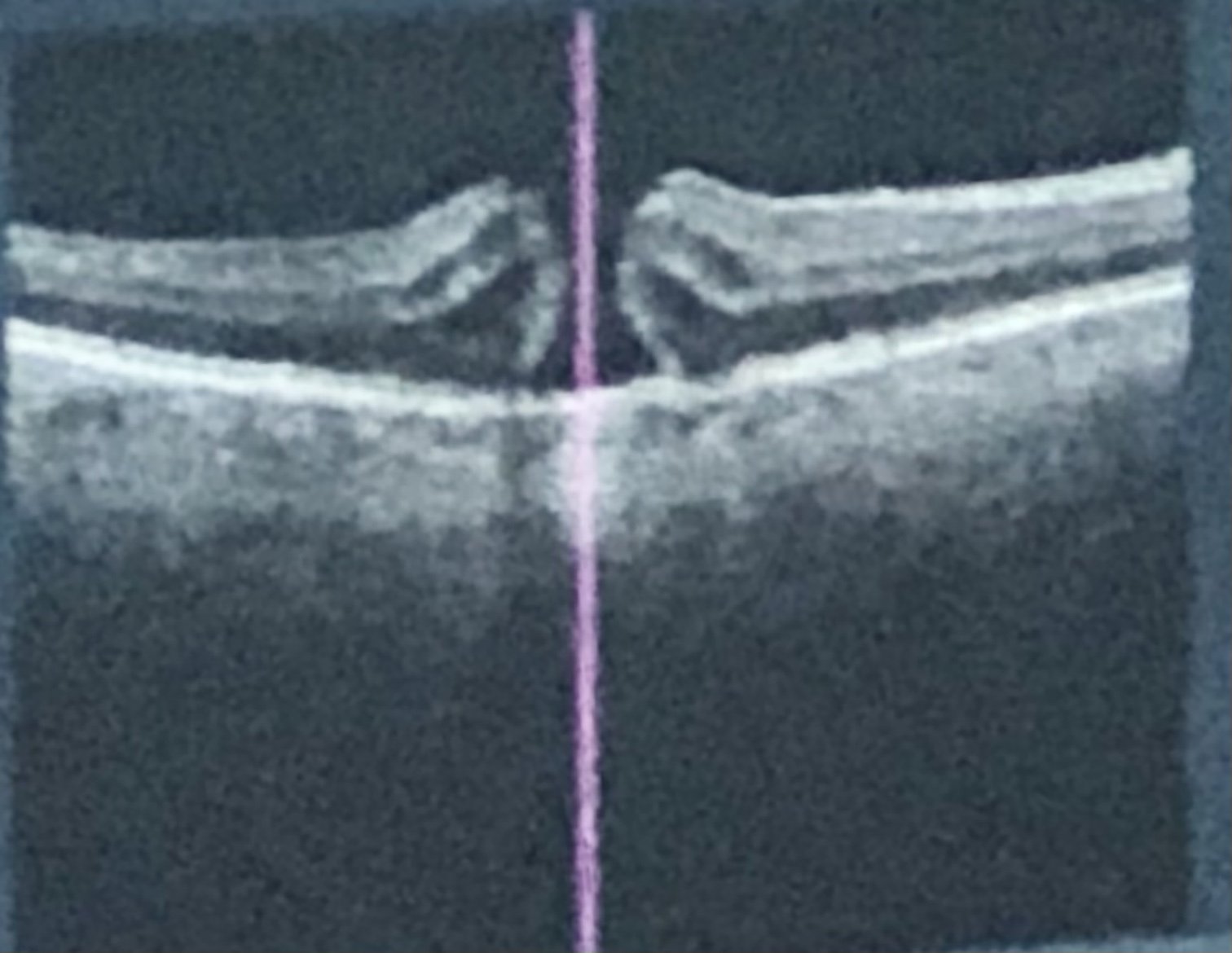 Macular hole discovered February 2026