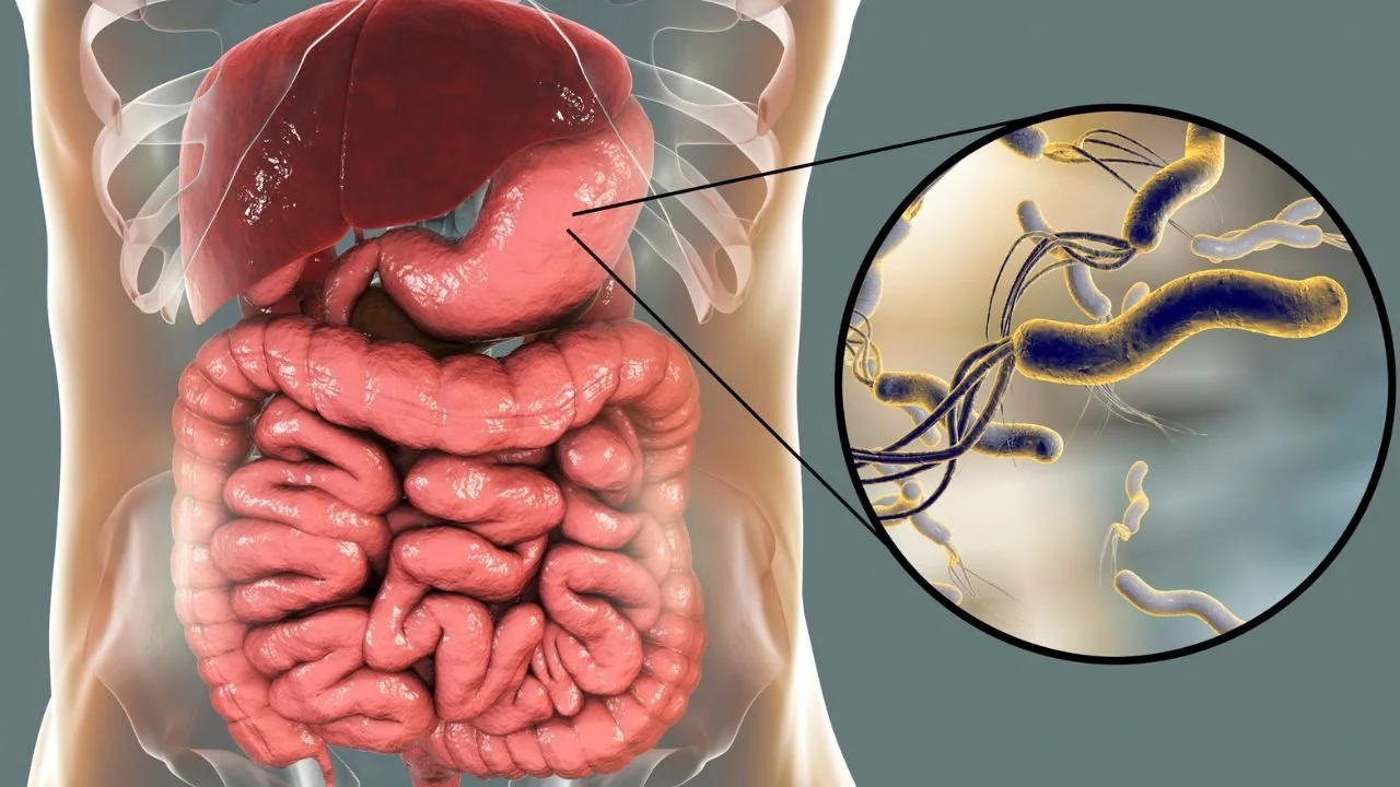 How to Remove H.Pylori from the Stomach