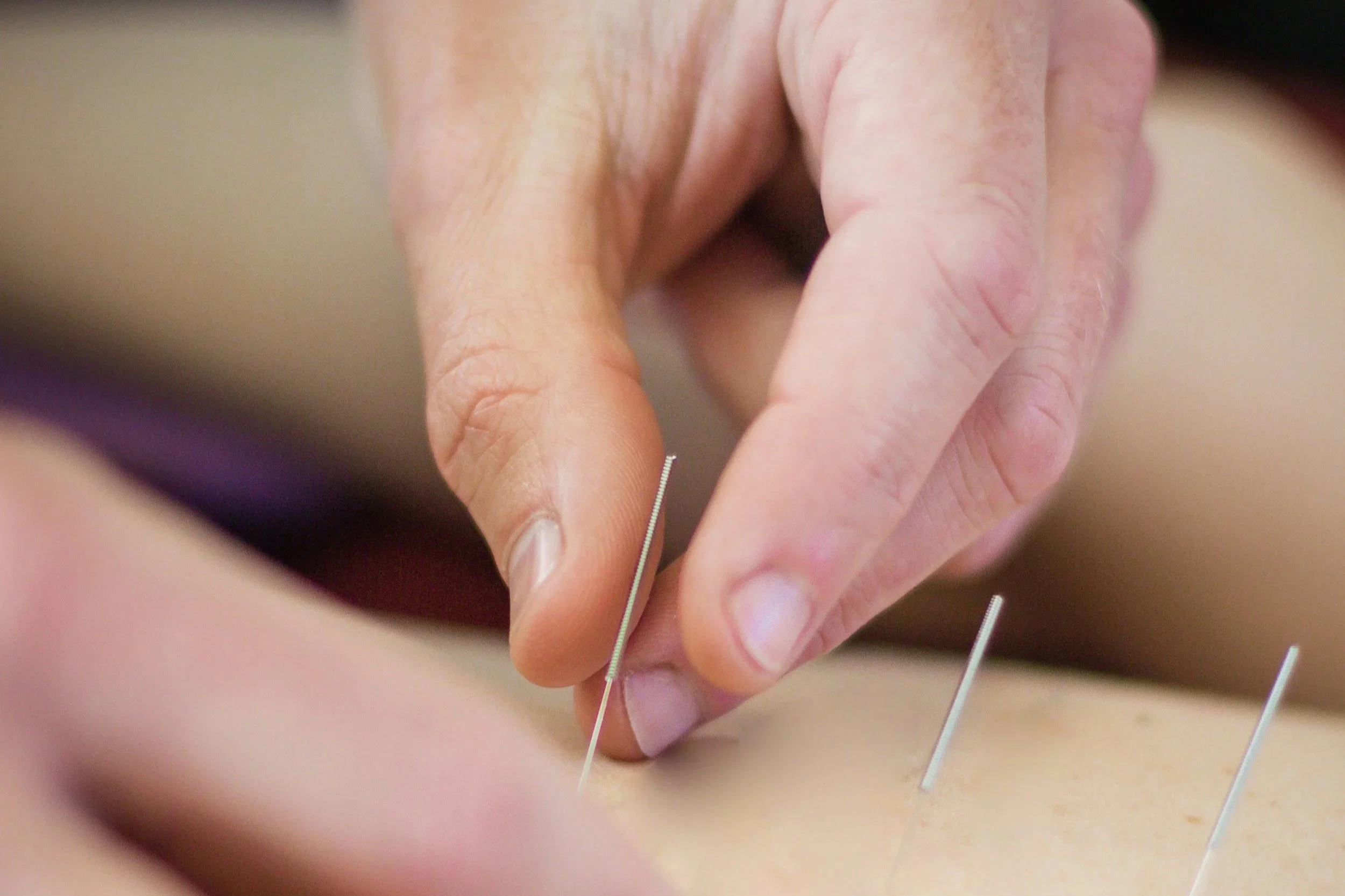 Acupuncturist inserting acupuncture needles during treatment in Sebastopol