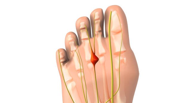 A medical illustration of a foot showing the anatomy of the nerves and a bunion on the big toe.