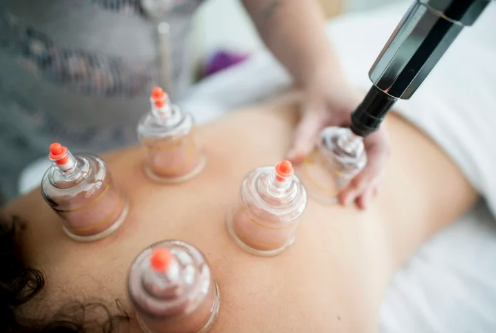 Cupping being performed on back of a patient