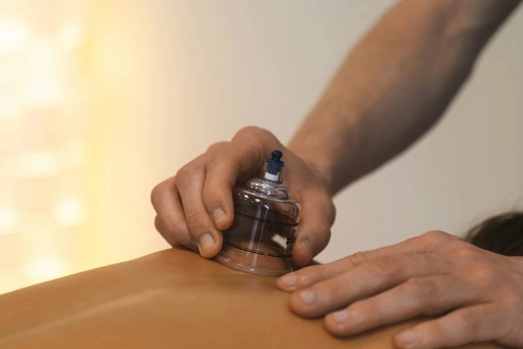 cupping near me acupuncture acupuncturist near me