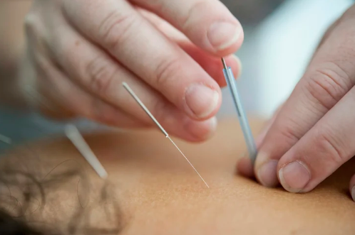 Close-up of acupuncture needle being inserted in back